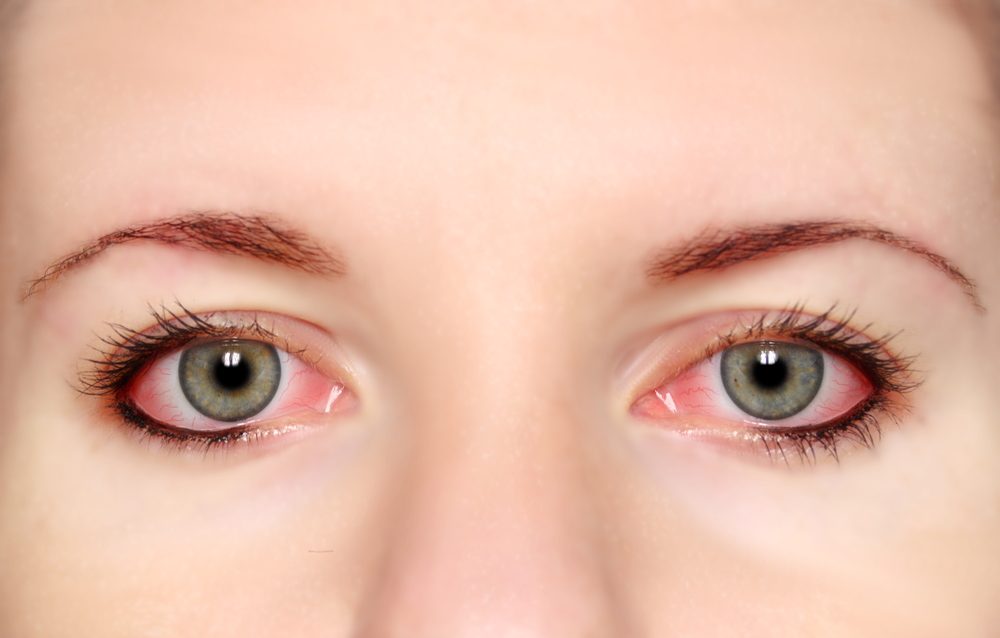 Understanding Eye Allergies