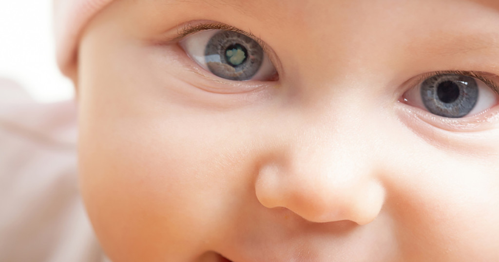 congenital-cataract-baby